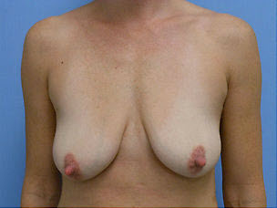 Before Image: Patient # 98814 - front