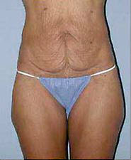Before Image: Patient # 58183 - front