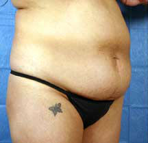 Before Image: Patient # 99846 - front