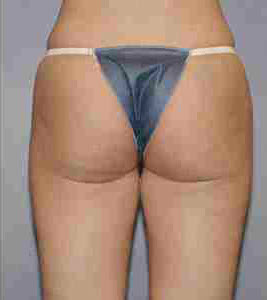 After Image: Patient # 93344 - front