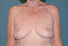 After Image: Patient # 71625 - front