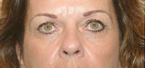 Before Image: Patient # 19441 - 