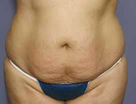 Before Image: Patient # 65074 - front