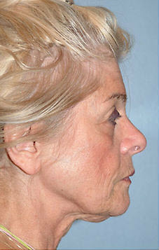 Before Image: Patient # 53232 - front