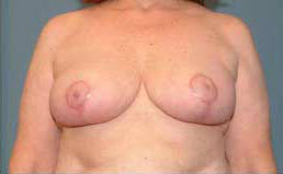 After Image: Patient # 82697 - front