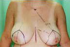 Before Image: Patient # 62107 - front