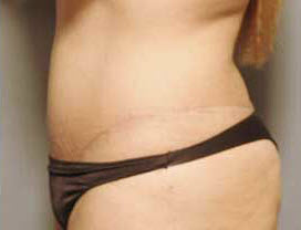 After Image: Patient # 65074 - front