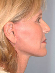 After Image: Patient # 45203 - front