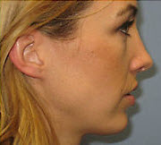 After Image: Patient # 97414 - front
