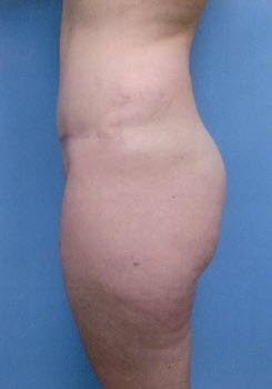 After Image: Patient # 88045 - front