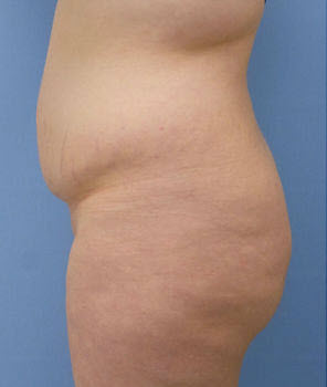 Before Image: Patient # 28534 - front