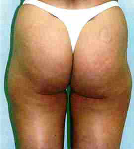 Before Image: Patient # 32499 - front