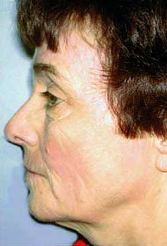 After Image: Patient # 25527 - front