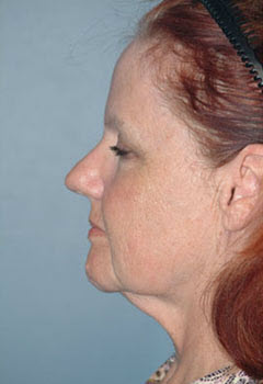 Before Image: Patient # 64128 - front