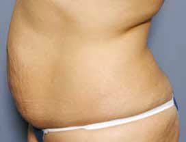 Before Image: Patient # 65074 - front