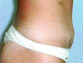 After Image: Patient # 42393 - front