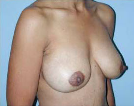 After Image: Patient # 75580 - front