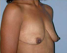 Before Image: Patient # 75580 - front
