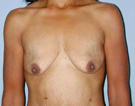 Before Image: Patient # 75580 - front