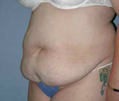 Before Image: Patient # 30777 - front