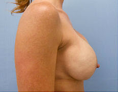 Before Image: Patient # 27241 - front
