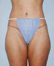 After Image: Patient # 58183 - front