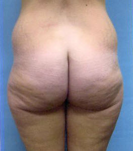 Before Image: Patient # 22881 - front