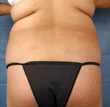 Before Image: Patient # 99846 - front