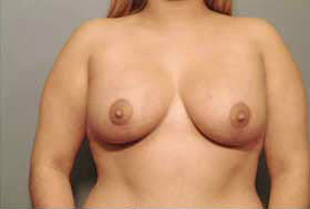 After Image: Patient # 45931 - front