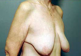 Before Image: Patient # 71625 - front