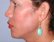Before Image: Patient # 97273 - front