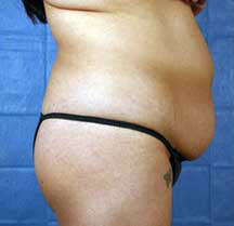 Before Image: Patient # 99846 - front