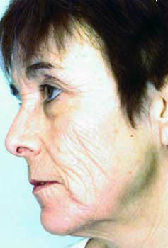 Before Image: Patient # 25527 - front