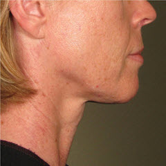 After Image: Patient # 97368 - 