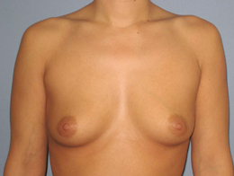 Before Image: Patient # 53743 - front