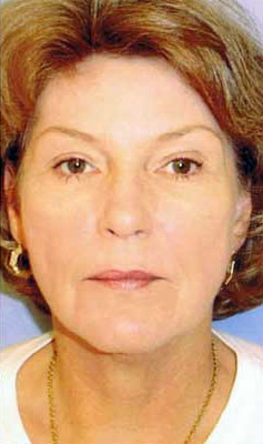 After Image: Patient # 94840 - front