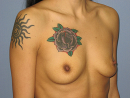 Before Image: Patient # 27012 - front