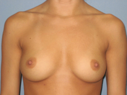 Before Image: Patient # 48191 - front