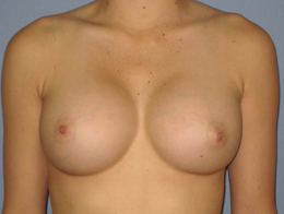 After Image: Patient # 63859 - front