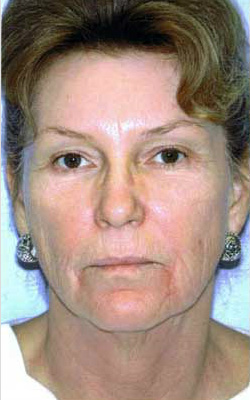 Before Image: Patient # 94840 - front
