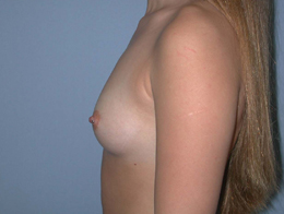 Before Image: Patient # 95705 - front