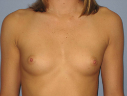 Before Image: Patient # 63859 - front