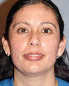 After Image: Patient # 48035 - front