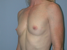 Before Image: Patient # 28297 - front