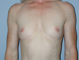 Before Image: Patient # 28297 - front