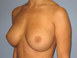 After Image: Patient # 86786 - front