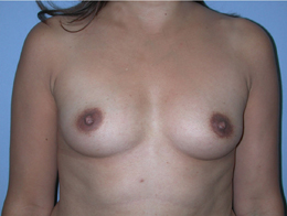 Before Image: Patient # 63024 - front
