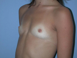 Before Image: Patient # 68444 - front