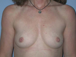 Before Image: Patient # 98811 - front