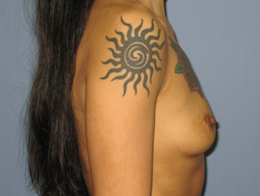 Before Image: Patient # 27012 - front